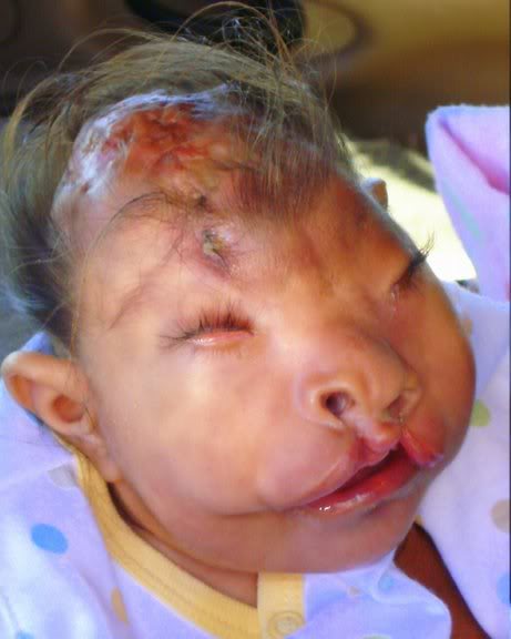 Samoan-Deformed-baby